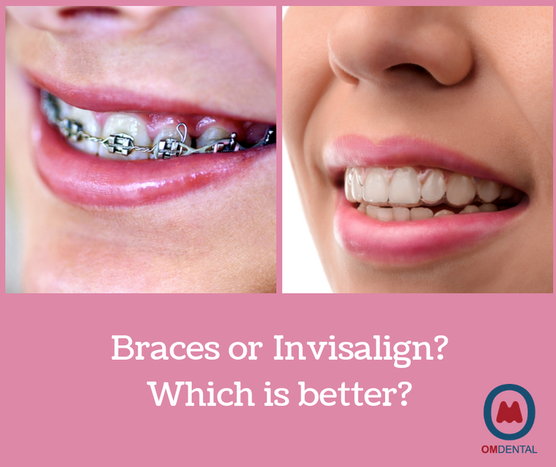 Understanding the difference between braces and Invisalign